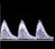 <p>This is a doppler at the umbilical artery.</p><ol><li><p>What waveform is seen here?</p></li><li><p>Is it normal or abnormal?</p></li></ol><p></p>