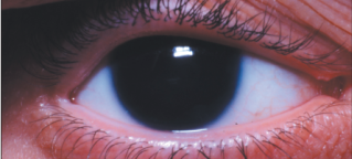 <p>term. Aniridia </p>