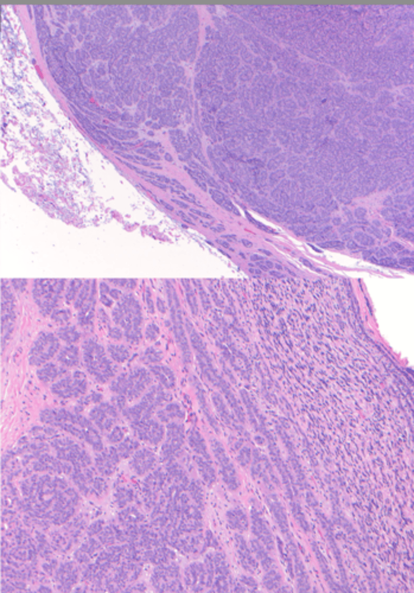 <p>-Various histologic patterns</p><p>-Cells line up in single file line "Kindergarten filing"</p><p>-Perineural and Perivascular invasion</p>
