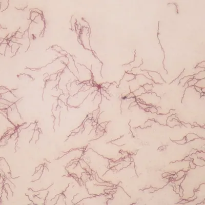 <p><strong> is a spirochete bacterium that causes Lyme disease.</strong></p><p><strong>Spirochete, Gram stain not reliable (seen by dark-field or Giemsa).</strong></p><p></p><p>It is identified through symptoms such as the bull's-eye rash, joint pain, and fatigue, confirmed by ELISA and Western blot testing.</p><p>Early disease is treated with doxycycline or amoxicillin, and severe cases may need intravenous ceftriaxone.</p><p>The infection is transmitted by Ixodes ticks, with mice as reservoirs and deer as tick hosts, and it adapts by changing its surface proteins.</p>