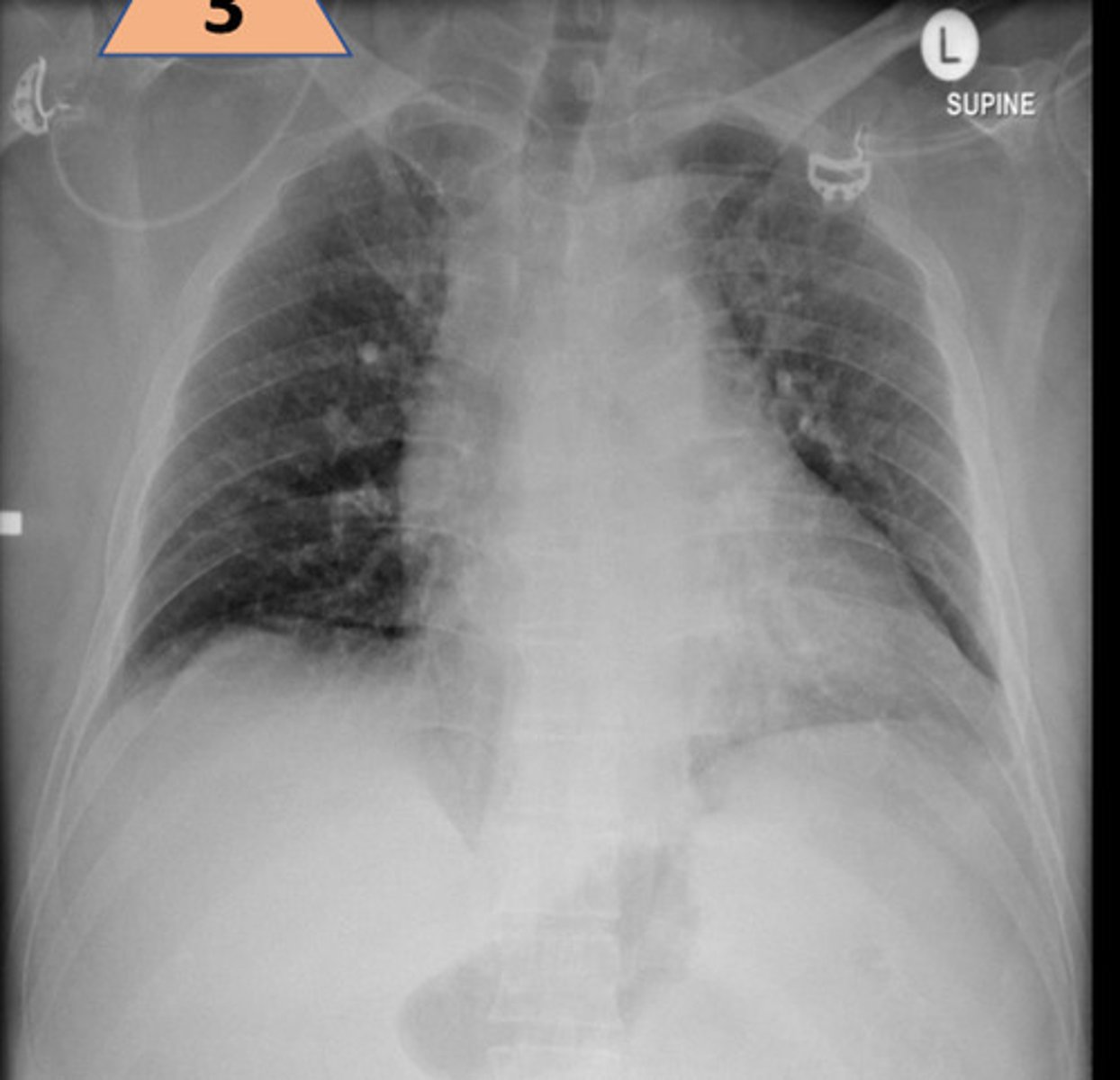 <p>M/C; this view is useful in assessing abdominal pathologies (bowel obstructions, calcifications, neoplastic changes)</p><p>* includes both halves of the diaphragm*</p>
