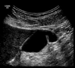 <p>Normal variant of GB</p>