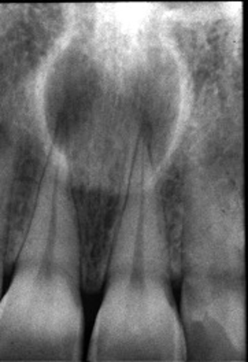 <p>ID the cyst:</p><p>•Well defined corticated periphery</p><p>•radiolucent</p><p>•Involves nasopalatine canal and incisive foramen</p><p>•Lesion is palatal to the teeth</p><p>•Maybe 'heart-shaped' due to superimposition of anterior nasal spine</p><p>•Lesion is superimposed over the apices of maxillary central incisors</p><p>•No changes in apical structures of these teeth (lamina dura, PDL)</p><p>•Vital teeth</p><p>•May displace these teeth</p>