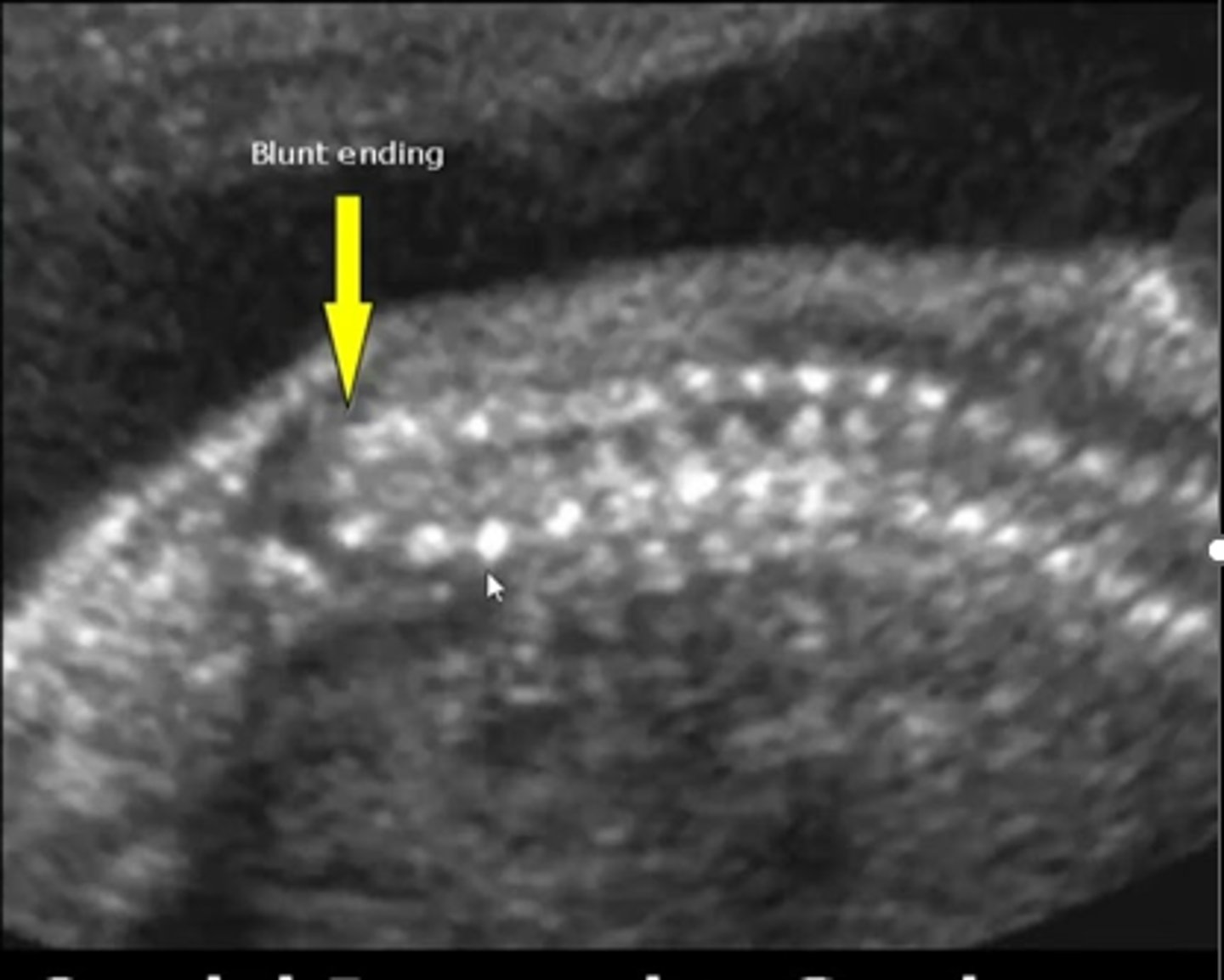 <p>Incomplete development of lower half of body</p><p>Sacral agenesis</p><p>Talipes - cubed feet</p><p>Short lower extremities</p><p>GU and GI anomalies</p>