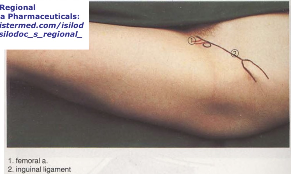 <p>n. femoralis blokados vieta</p>