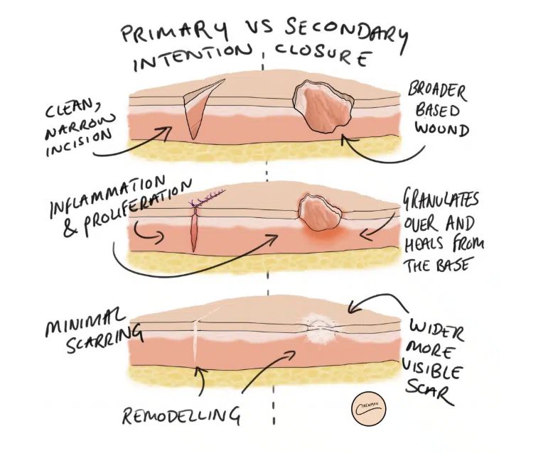 <ol><li><p>healing by <strong>primary </strong>intentions - the wound edges are in <strong>close apposition <u>, reepithelization dominates healing </u></strong></p></li><li><p>healing by <strong>secondary </strong>intention - the wound is more extensive and the wound edges are <strong>widely separated, </strong></p></li></ol><p></p>