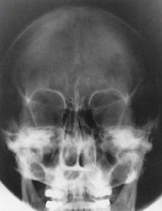 <p>What is this x-ray demonstrating?</p>