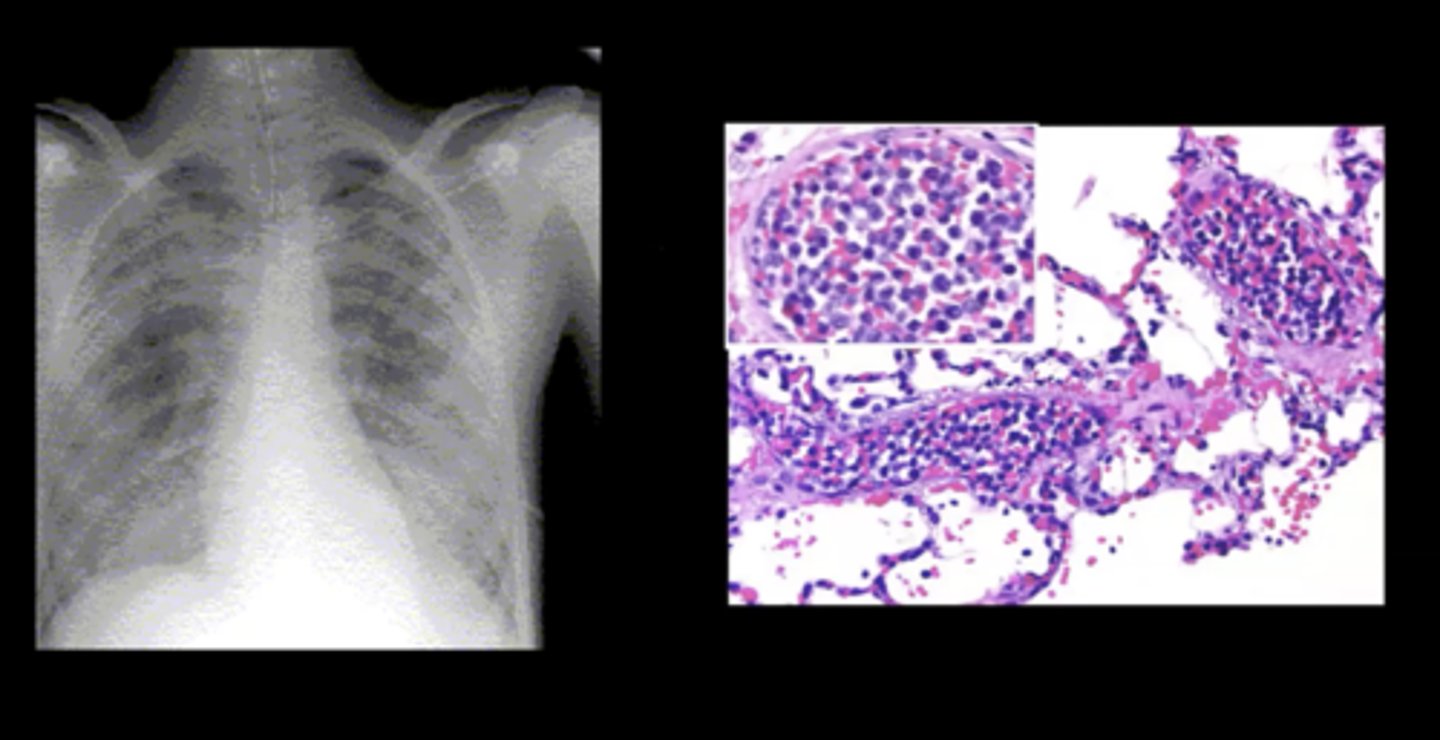 <p>Sudden shortness of breath and progressive dyspnea; caused by a WBC clot</p>