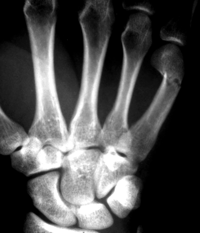 <p>fx of 5th metacarpal; often w/ displacement or angulations towards palmer surfaces</p>