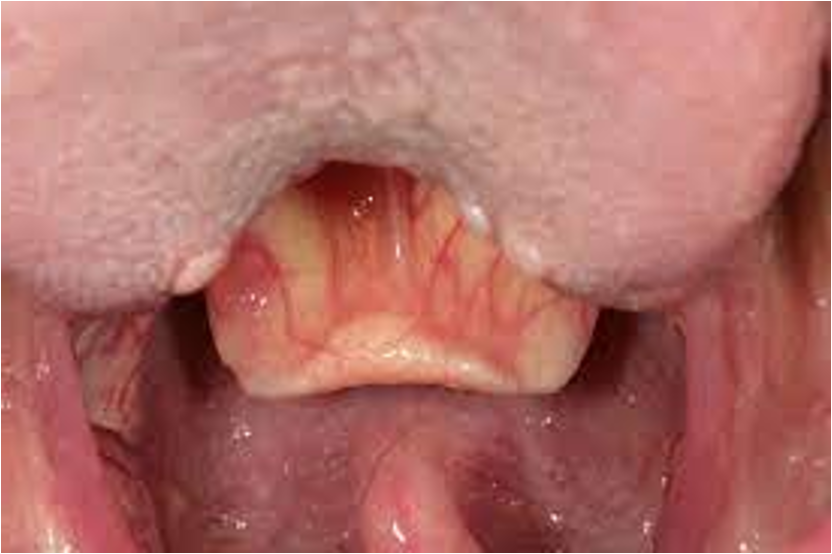 <p>What does this refer to</p><ul><li><p><strong>MCC= haemophilus influenza type B </strong></p></li><li><p>Rare - due to HiB vaccine</p></li><li><p>Kids ~ 3 months- 6 y/o</p></li><li><p>Males&gt;&gt;females</p></li></ul><p></p>