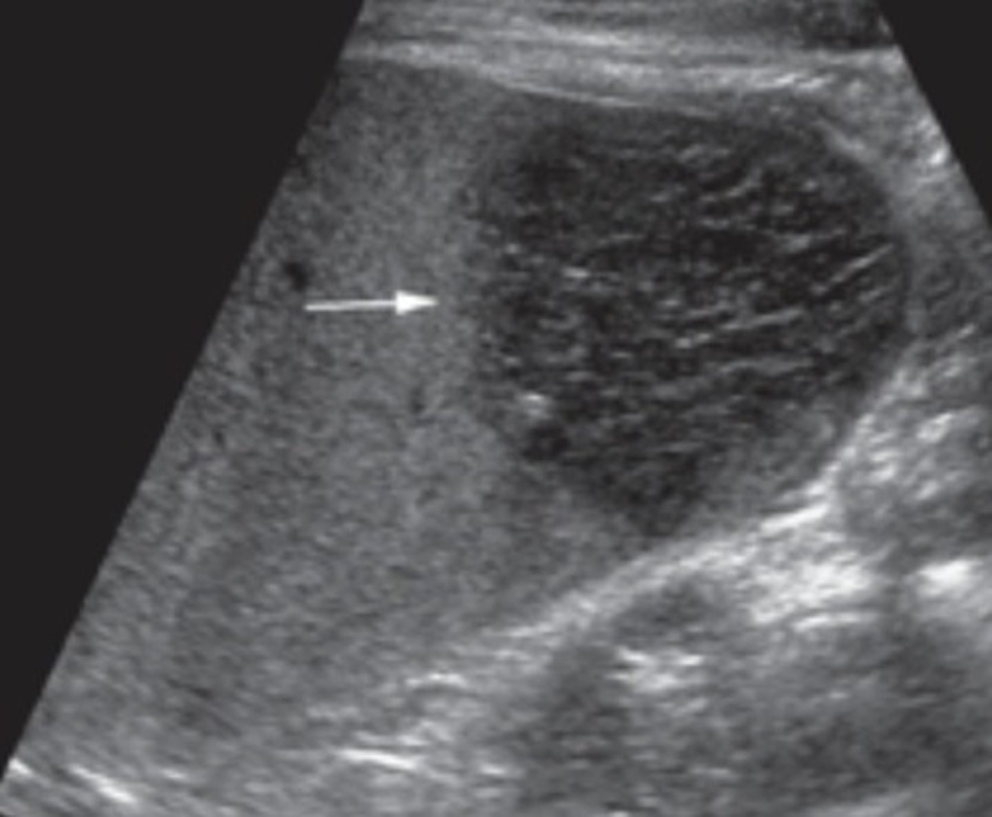 <p>Heterogenous appearance</p><p>Look for free fluid</p><p>Spleen looks enlarged</p>