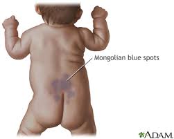 <p>What is a mongolian spot?</p>