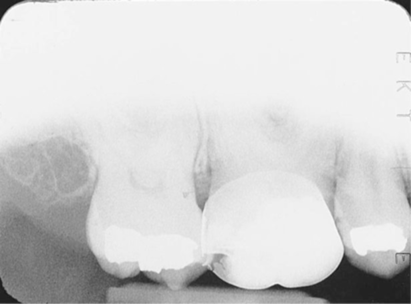 <p>Appears as a clear, unexposed area on a dental radiograph and may occur with a rectangular or round PID</p>