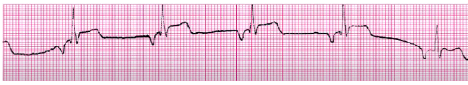 <p>rate 40-59</p><p>slow rates lead to decreased CO (change in LOC, SOB, chest pain, decreased BP)</p><p>atropine, temporary pacer</p><p>treat underlying cause (RHD, valve disease, post-CABG, hypoxia, Ca Channel Blockers, BBs, increased vagal tone)</p>