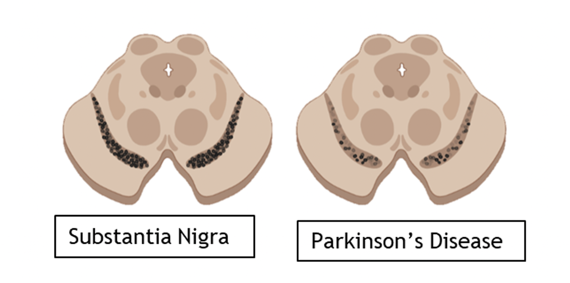 <p>In Parkinson’s the <strong>Substantia Nigra degenerates</strong></p><p><strong>Lewy Bodys</strong> form – abnormal aggregations of protein</p><p>This leads to the <strong>movement and</strong> <strong><em>initiation</em></strong> <strong>difficulties</strong> seen in Parkinson’s</p><p>Lose <strong>nigrostriatal pathway</strong> → lose upper/higher control of processing movement</p>
