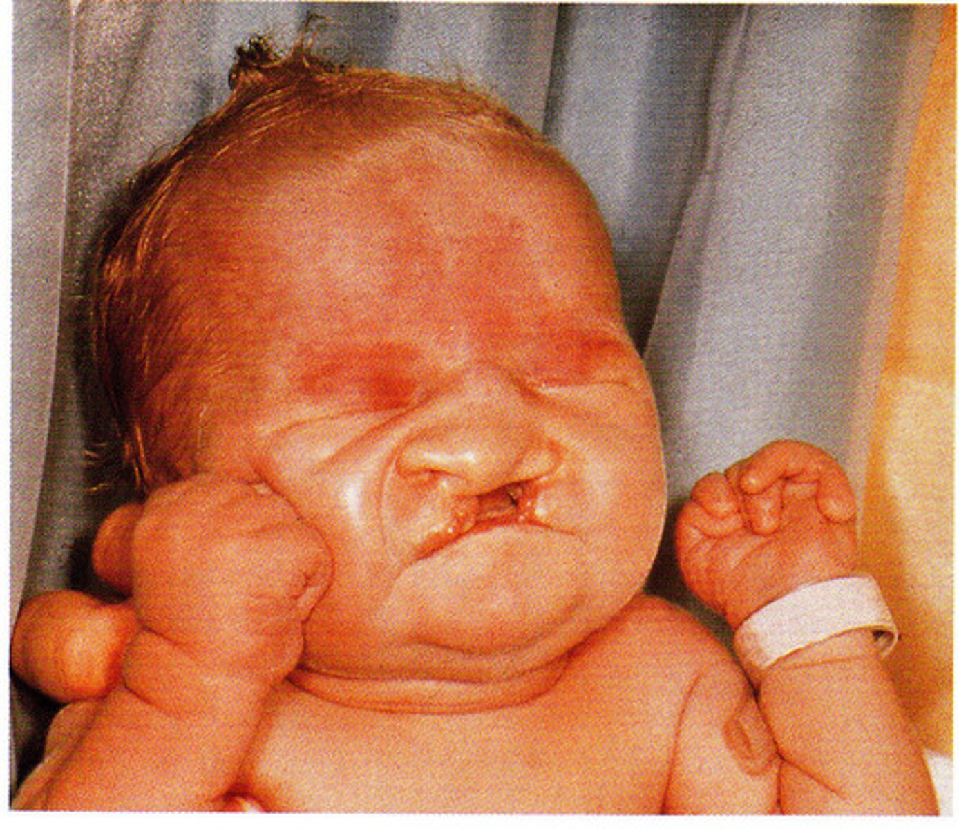 <p>-abnormalities in multiple organs</p>