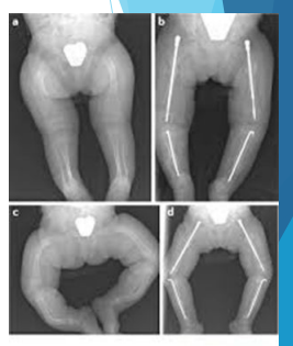 <p>Rodding - repeated fractures, angulation </p><p>Spinal fusion (scoliosis) </p>