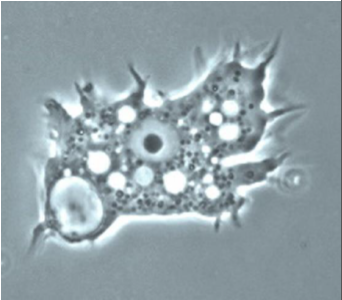 <p><strong>Identify the parasite/stage, and name the disease induced by this parasite in the CNS.</strong></p><ul><li><p><em>Acanthamoeba castellanii</em> trophozoite</p></li><li><p>Causes <strong>Granulomatous Amoebic Encephalitis (GAE).</strong></p></li></ul><div data-type="horizontalRule"><hr></div><p><strong>Mention direct diagnosis for this infection (techniques and detected stages).</strong></p><ul><li><p><strong>Direct microscopy and staining</strong>, or <strong>culture</strong> for detection of <strong>trophozoites and cysts</strong> in tissues or CSF.</p></li></ul><div data-type="horizontalRule"><hr></div><p><strong>Mention two morphological characteristics of this stage.</strong></p><ul><li><p>About <strong>20–40 µm</strong>, with <strong>multiple spiky pseudopodia.</strong></p></li></ul><div data-type="horizontalRule"><hr></div><p><strong>Mention the culture media you can use to confirm the diagnosis.</strong></p><ul><li><p><strong>Non-nutrient agar (1.5%) enriched with <em>Escherichia coli</em>.</strong></p></li></ul><div data-type="horizontalRule"><hr></div><p><strong>List human tissue/parts affected by this parasite.</strong></p><ul><li><p><strong>Brain, eye, and skin.</strong></p></li></ul><p></p>
