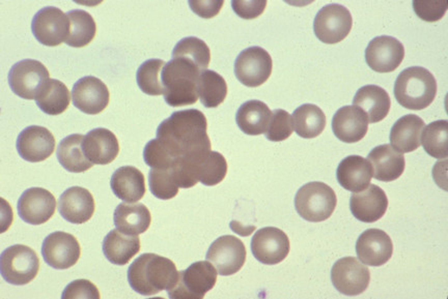 <p>- RBCs clump due to antibodies</p><p>- Etiologies: Cold agglutinin syndrome</p><p>Either: Warm autoimmune hemolytic anemia OR cold autoimmune hemolytic anemia</p>