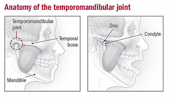 <ul><li><p>= a group of disorders where a dysfunction of the maxillary joint and/or masticatory muscles occurs</p></li><li><p><span style="font-family: Merriweather, Helvetica, serif">disc displacement (check photo) can cause acute pain, usually with restricted movement</span></p></li><li><p><span style="font-family: Merriweather, Helvetica, serif">chronic pain in the region of the maxillary joint radiating into the temporalis that is exacerbated by chewing can be caused by discopathy and osteoarthritis</span></p></li><li><p><span style="font-family: Merriweather, Helvetica, serif">impaired occlusion and chronic tension in the masticatory muscles can be a contributory factor or a primary cause</span></p></li></ul>