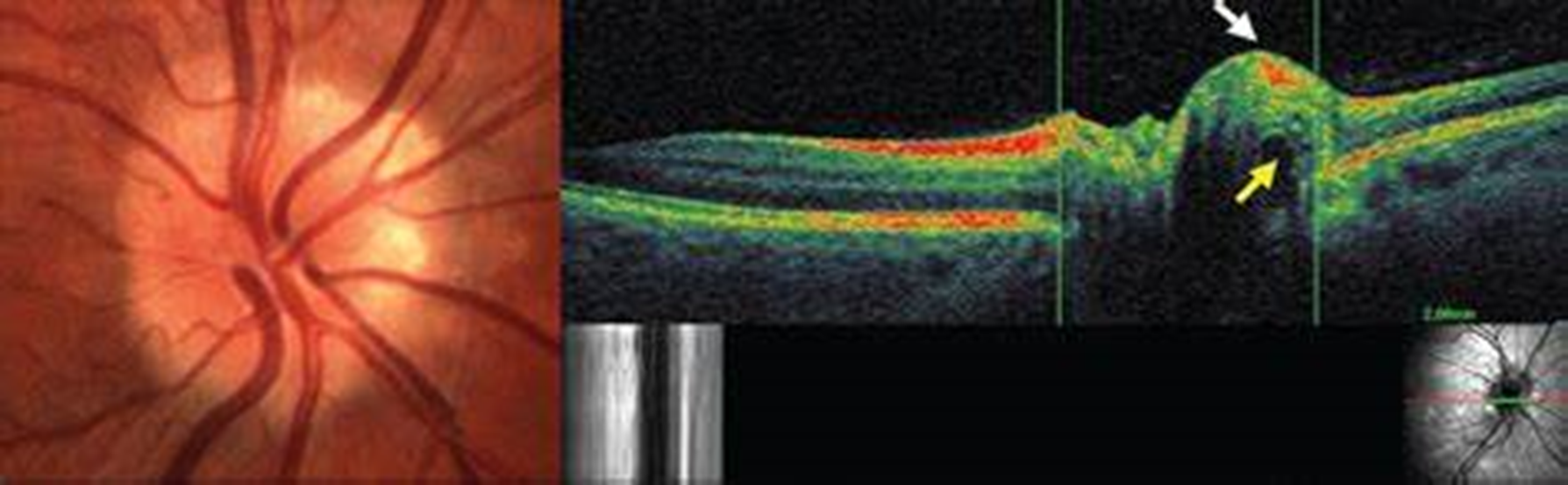 <p><span>Hyperreflective, spherical/irregular anterior border with internal hyporeflective core</span></p><ul><li><p>Adjacent NRR RNFL and cpRNFL scan can detect RNFL loss/changes</p></li></ul>