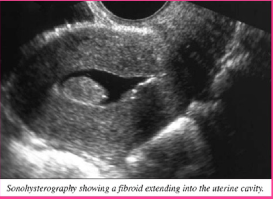 <p>What is sonohysterography?</p>