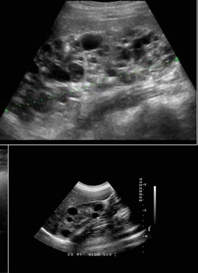 <p>What is the sonographic appearance of <span>ADPKD (</span>autosomal dominant (adult) polycystic kidney disease)?</p>