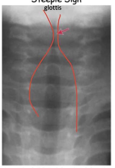 <p>Xray sign for Croup</p>
