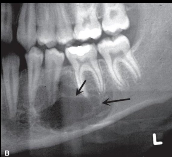 <p>How would you describe Central Giant Cell Granuloma (CGCG)?</p>