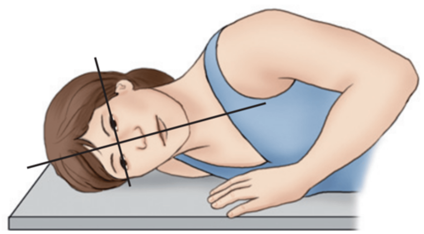 <p>a tipping or slanting of the MSP laterally, even though rotation may not be present.</p><p>-one area closer to the shoulder than the other</p><p>-usually evident by looking at orbital plates, body of mandible, or horizontal structures</p>