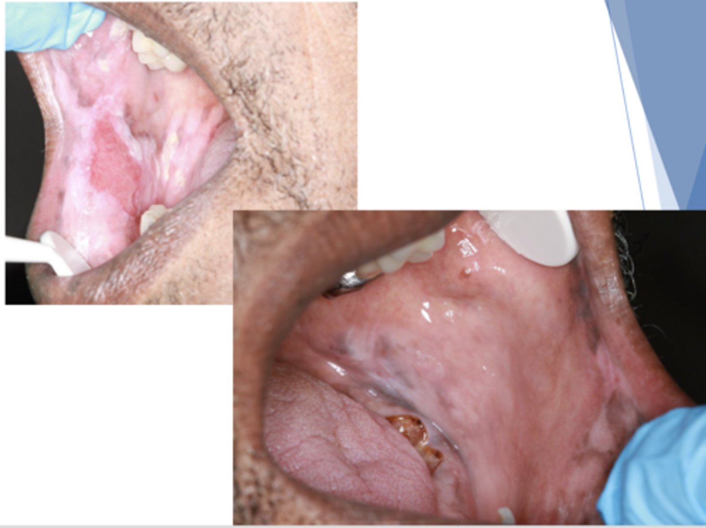 <p>Patient presents with these oral lesions but reports no other symptoms. Patient also has some hyperpigmented lesions on skin. What is the most likely differential?</p>