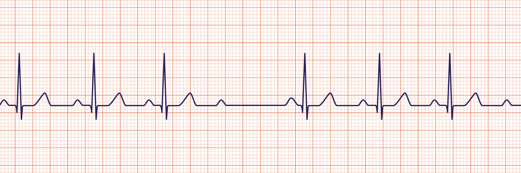 <p><span>A Mobitz Type II heart block is characterized by an intermittent dropped QRS that is not in a Mobitz Type I pattern. The Mobitz Type II block must be evaluated since it is one that can rapidly progress to a complete heart block.</span></p>
