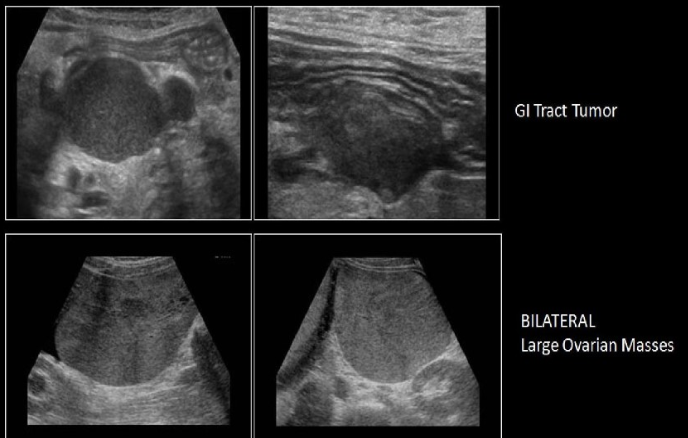 <p>pt has pain + bloating. she has hx of GI tract carcinoma. which is the most likely sono finding in pelvis</p><p>a) lymphadenopathy + bilateral ovarian cyst formation</p><p>b) krukenberg tumor or ovary + peritoneal cysts</p><p>c) lymphadenopathy + krukenberg tumor of ovary</p><p>d) lymphadenpathy + brenner tumor of ovary</p>