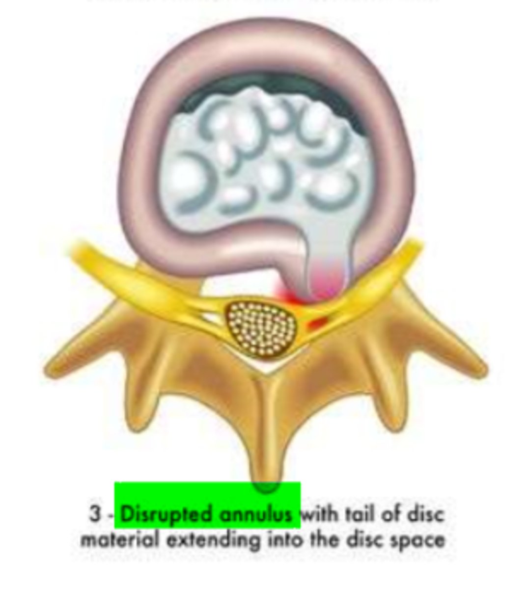 <p>nuclear material has perforated the annulus fibrosis </p><p>*leaked into epidural space</p>