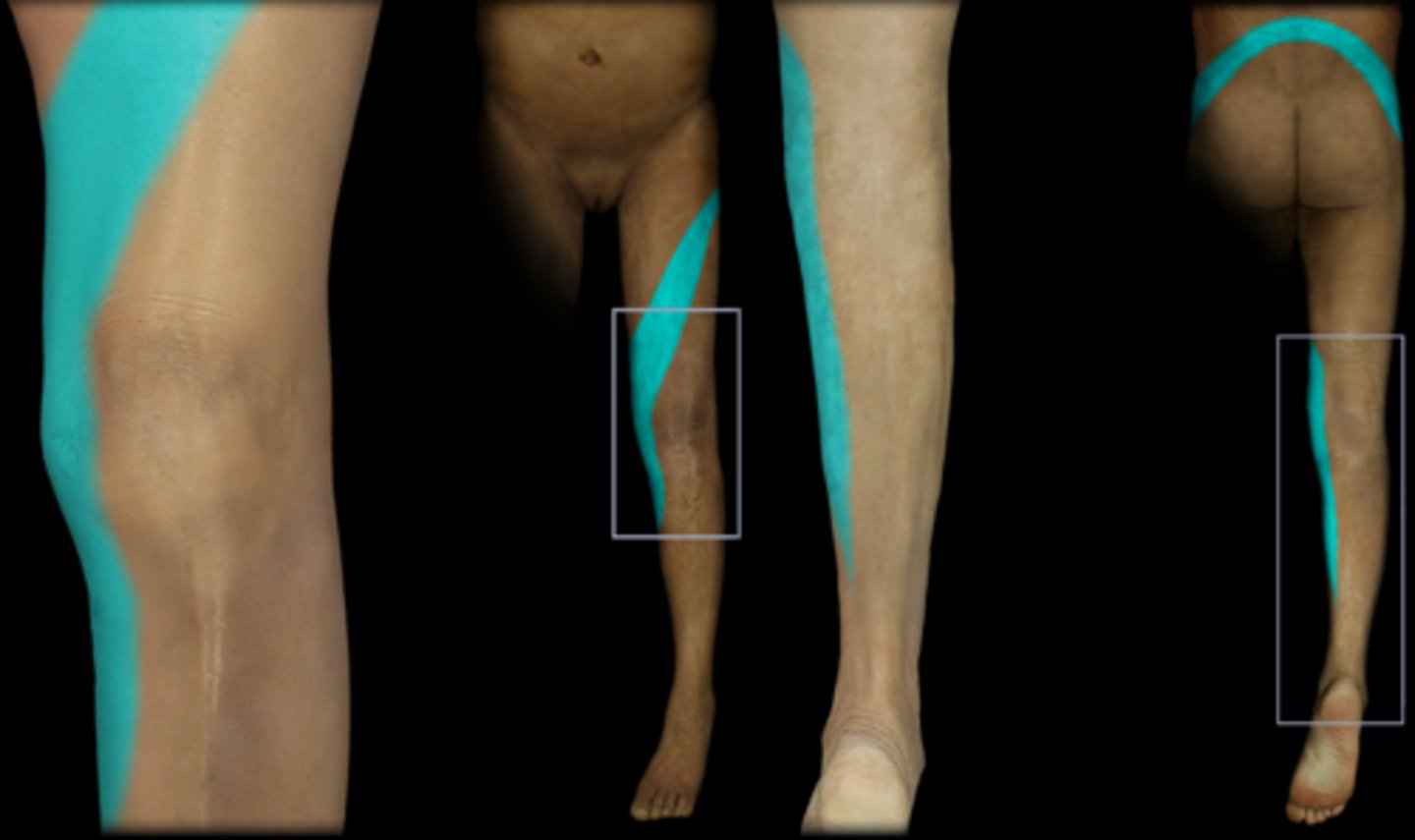 <p>Dermatome: Back, upper buttock, anterior thigh/knee, medial lower leg</p><p>Muscles innervated: Psoas, quads, thighs</p><p>Reflexes (if any): Knee jerk, prone knebend positive, pain on full SLR</p><p>Paresthesias: Medial knee, anterior lower leg</p>