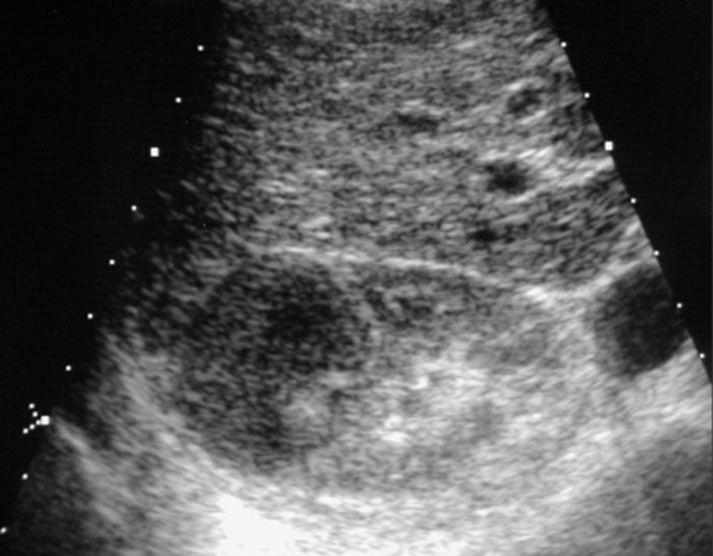 <p>-enlarged hypoechoic kidneys</p><p>-mass may stimulate a cyst wo post enhancement</p>