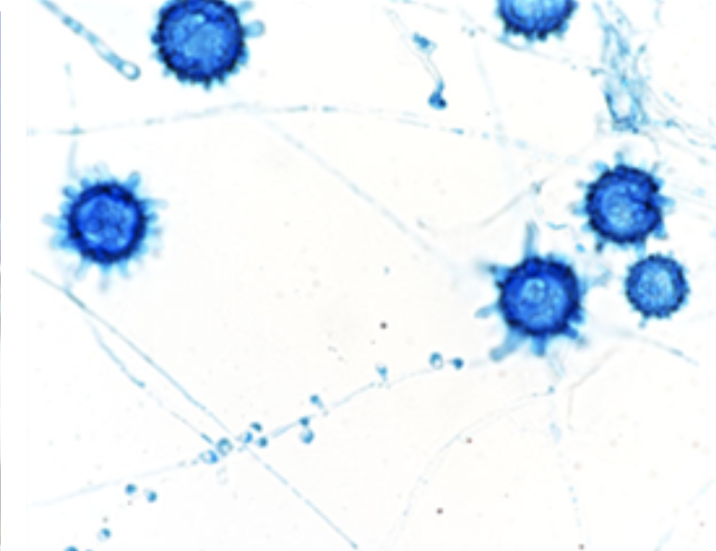 <p>An organism was isolated from a induced sputum specimen from a patient living in the Midwestern United States. Pictured below is the colony from Sab Dex agar and a lactophenol blue tease mount. What is the identification of this organism?</p>