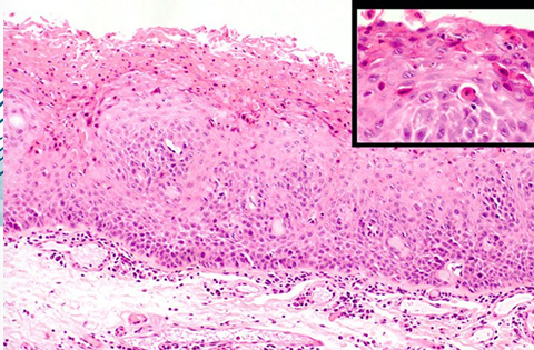 <p>-acanthosis</p><p>-hyperparakeratosis</p><p>-dyskeratosis (dysregulated keratin production) in superficial epithelial cells</p><p>-dyskeratosis makes cells look like they are engulfed by adjacent cells → cell-within-a-cell appearance</p>