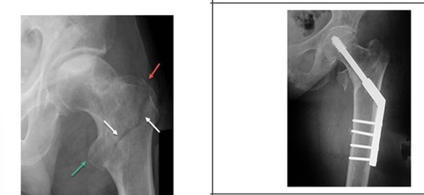 <p>What type of hip pinning is shown?</p>