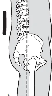 Decreased secondary curve, base of spine is too straight