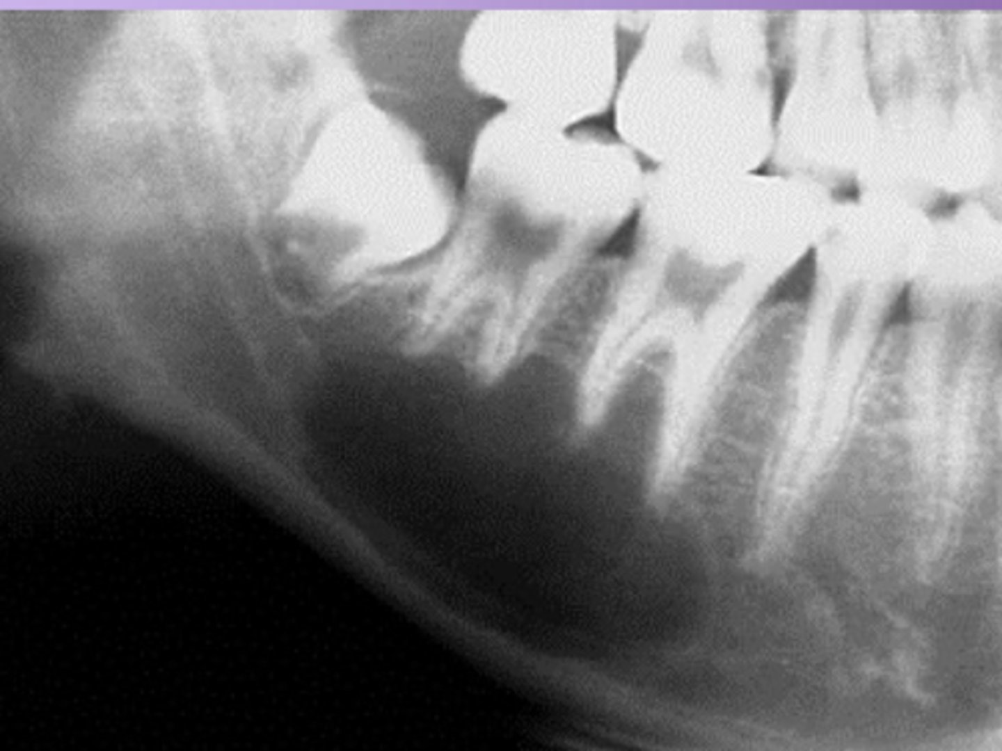 <p>= Well defined RL, scalloping</p><p>- #1: test teeth</p><p>- #2: biopsy</p>