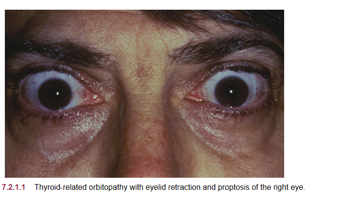 <p>thyroid eye  disease </p>
