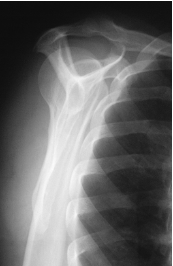 <p>evaluation criteria for&nbsp;<span style="color: rgb(255, 255, 255);">Scapular Y Lateral Shoulder – Posterior Oblique Position (AP Projection)</span></p>