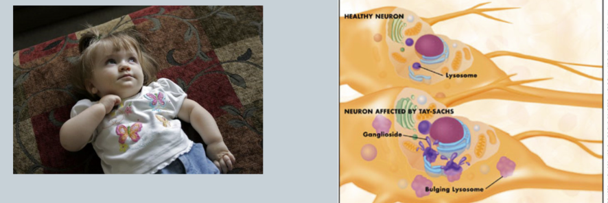 <p><span>Deficiency of hexosaminidase =&gt; accumulation of gangliosides in brain (break down cells) =&gt; mental retardation (hearing/vision loss)				</span></p><p><span>CNS DISEASE		</span></p><p><span>Common in ASHKENAZIC JEWS&nbsp;</span></p>
