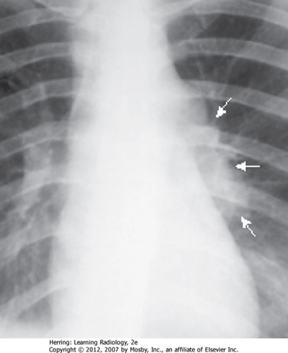 <p>initial infection of tuberculosis, Ranke complex</p>