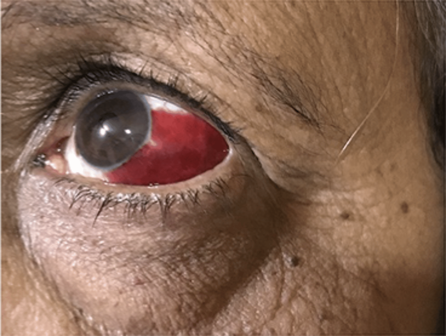 <p>name the conjunctival abnormality</p>