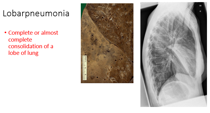 <p><span>Complete or almost complete consolidation of a lobe of lung</span></p>