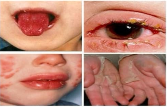 <p><strong>Kawasaki Disease: Symptoms</strong></p><p>-Acute Phase (1-2 weeks)</p><ul><li><p>High _____, bilateral ____________, mucosal changes with ____ cracked lips and _________ tongue, cervical LAD, __________ of hands and feet, and ____ on the chest and inguinal area </p></li></ul><p>-Subacute Phase (until 4th week)</p><ul><li><p>Gradual resolution of fever and other symptoms, ___________ of skin (fingers/toes MC), and ________ artery aneurysms </p></li></ul><p>-Convalescent Phase (until 6-8 weeks) </p><ul><li><p>Disappearance of symptoms, _____ lines of fingernails </p></li></ul><p></p>