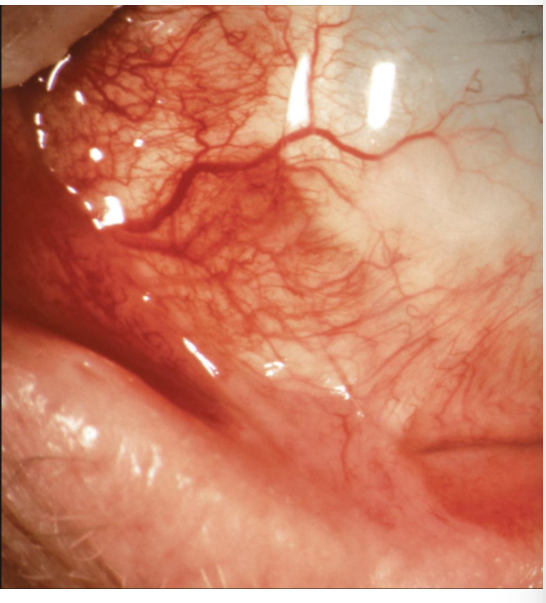 <ol><li><p>– first 7-10 days</p><ol><li><p>• Mucopurulent or <u>pseudomembranous conjunctivitis</u></p></li><li><p>• Episcleritis and Iritis</p></li></ol><p></p></li></ol><p></p>