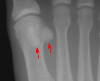 <p>Sesamoid bones</p>